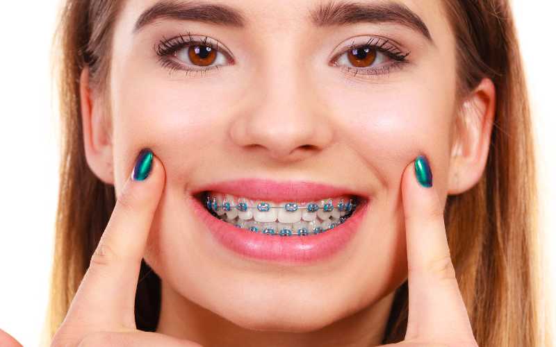 Aparelho dentário tradicional Como Funciona, Vantagens e Cuidados