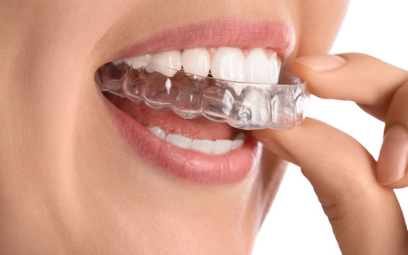 alinhador invisível