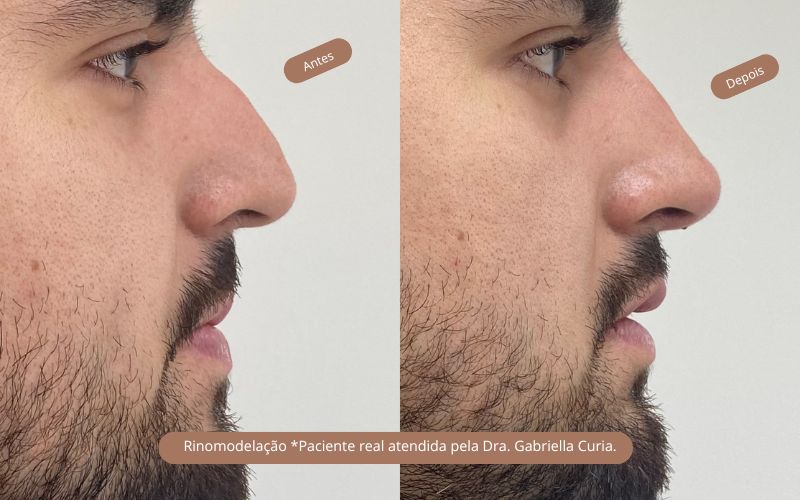 Rinomodelação: Como Funciona, Benefícios e Cuidados