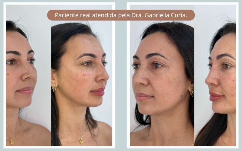harmonização facial