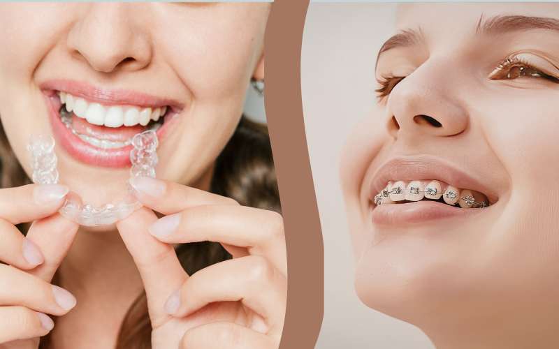 aparelho-ortodontico-alinhador-invisivel-vila-clementino