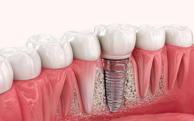 implante dentario dra gabriella curia